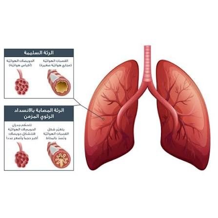 الانسداد الرئوي